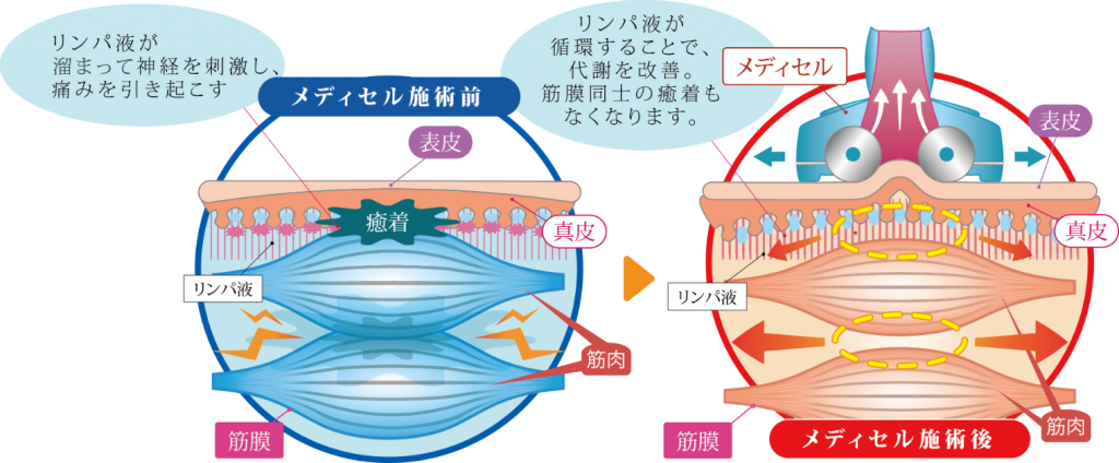 メディセルMedicell筋膜リリース治療院整骨院接骨院エステ整体院美肌